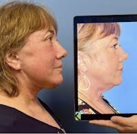 Facelift & Neck Lift Before & After Gallery - Patient 327557 - Image 1