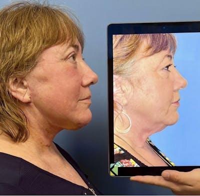 Facelift & Neck Lift Before & After Gallery - Patient 327557 - Image 1