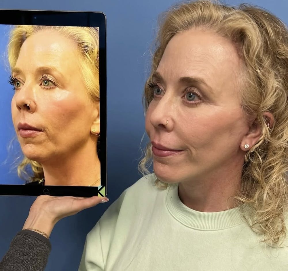 Facelift & Neck Lift Before & After Gallery - Patient 210782 - Image 1