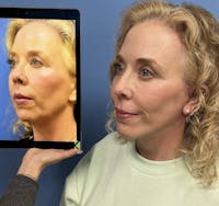 Facelift & Neck Lift Before & After Gallery - Patient 210782 - Image 1