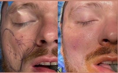 Facial Fat Transfer Before & After Gallery - Patient 113031 - Image 1