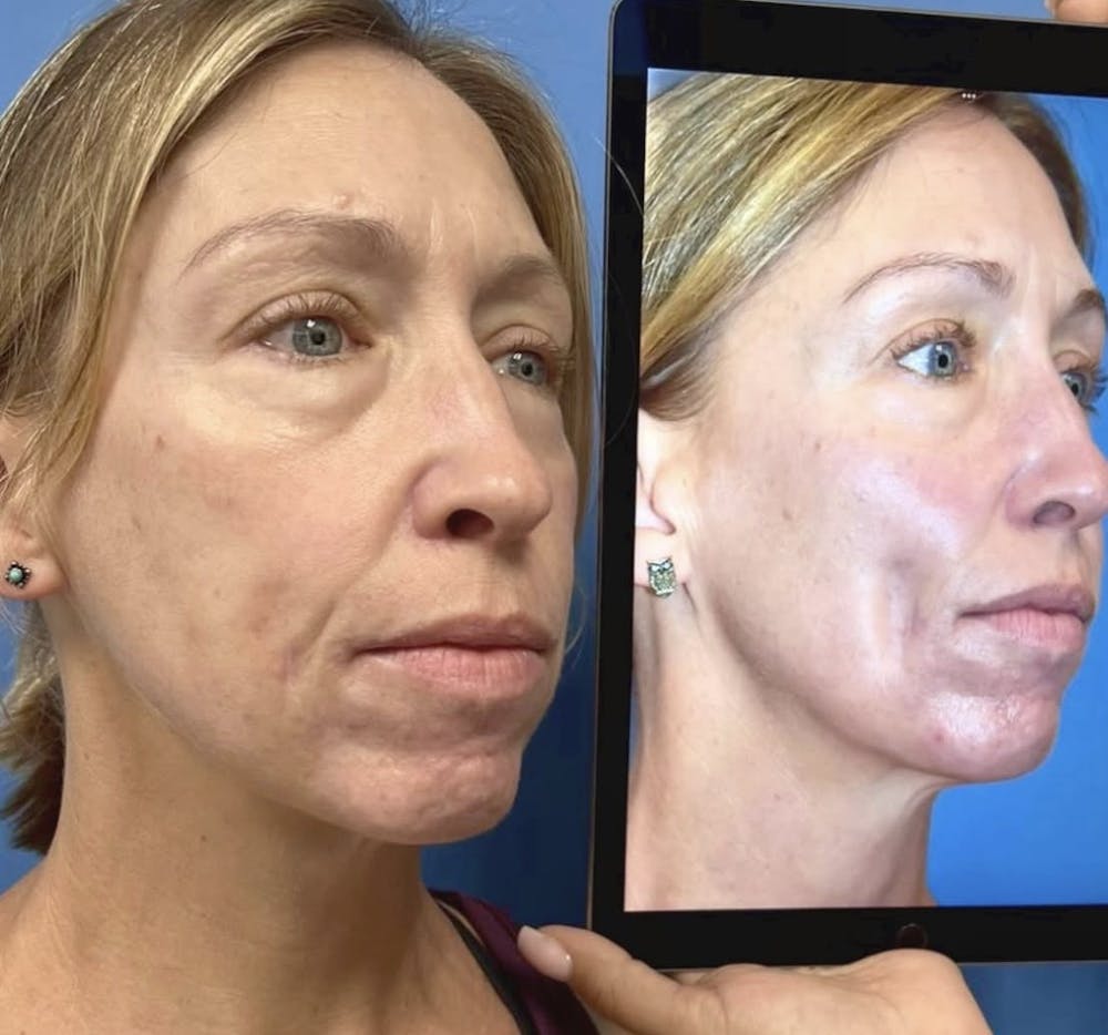 Facial Fat Transfer Before & After Gallery - Patient 212190 - Image 1