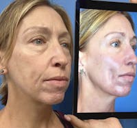 Facial Fat Transfer Before & After Gallery - Patient 212190 - Image 1