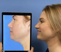 Neck Liposuction Before & After Gallery - Patient 285056 - Image 1