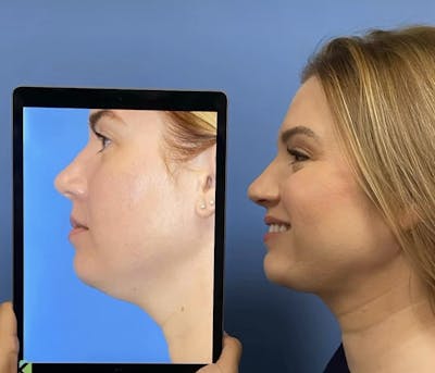 Neck Liposuction Before & After Gallery - Patient 285056 - Image 1