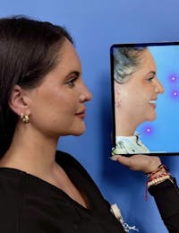 Rhinoplasty Before & After Gallery - Patient 317230 - Image 1