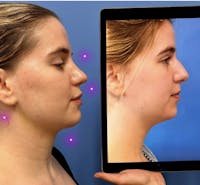 Rhinoplasty Before & After Gallery - Patient 188114 - Image 1