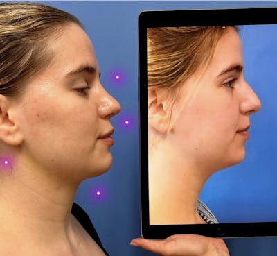 Neck Liposuction Before & After Gallery - Patient 416341 - Image 1