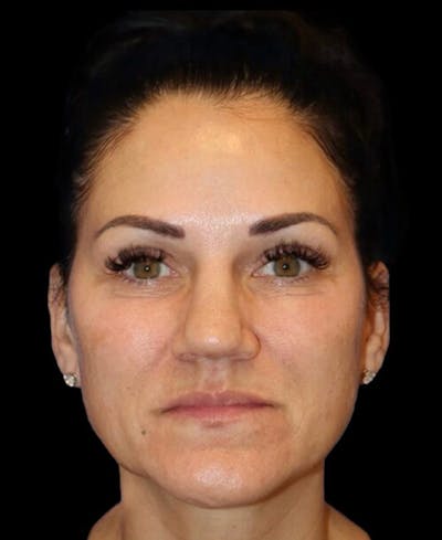Blepharoplasty (Eyelid Surgery) Before & After Gallery - Patient 237036 - Image 1
