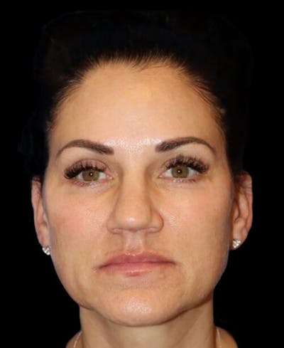 Blepharoplasty (Eyelid Surgery) Before & After Gallery - Patient 237036 - Image 2