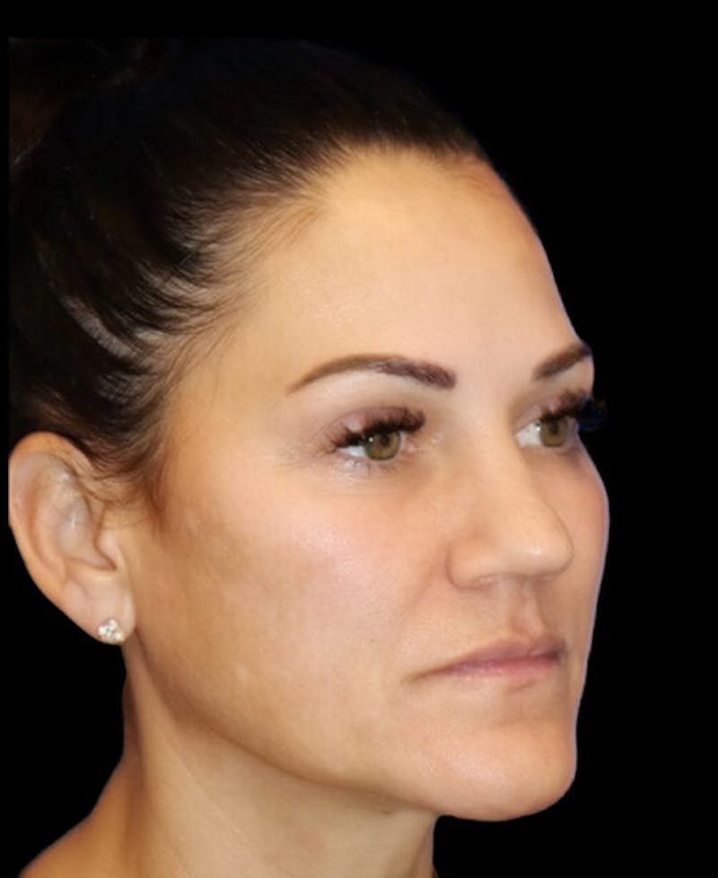 Blepharoplasty (Eyelid Surgery) Before & After Gallery - Patient 237036 - Image 3