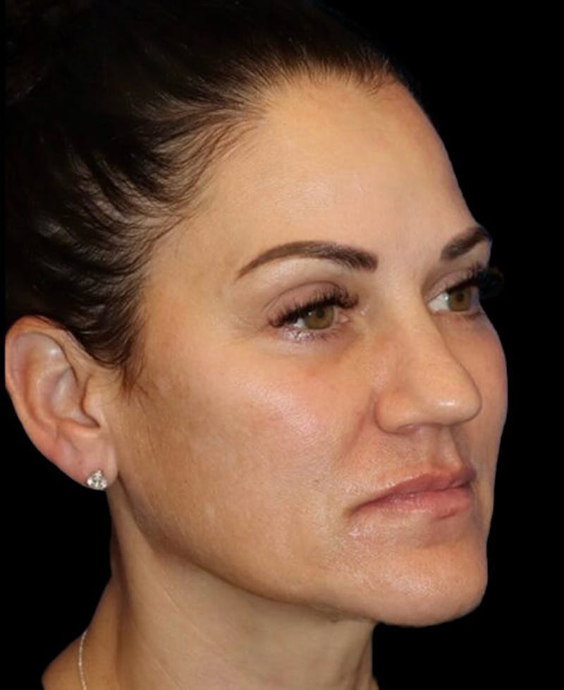 Blepharoplasty (Eyelid Surgery) Before & After Gallery - Patient 237036 - Image 4