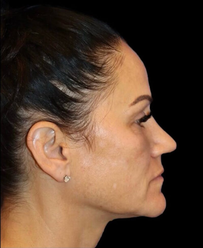 Blepharoplasty (Eyelid Surgery) Before & After Gallery - Patient 237036 - Image 5