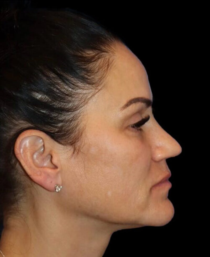 Blepharoplasty (Eyelid Surgery) Before & After Gallery - Patient 237036 - Image 6