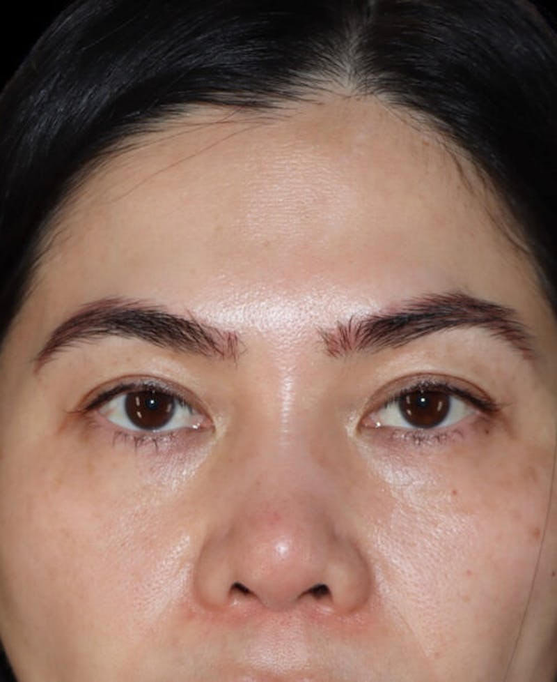 Blepharoplasty (Eyelid Surgery) Before & After Gallery - Patient 216175 - Image 1