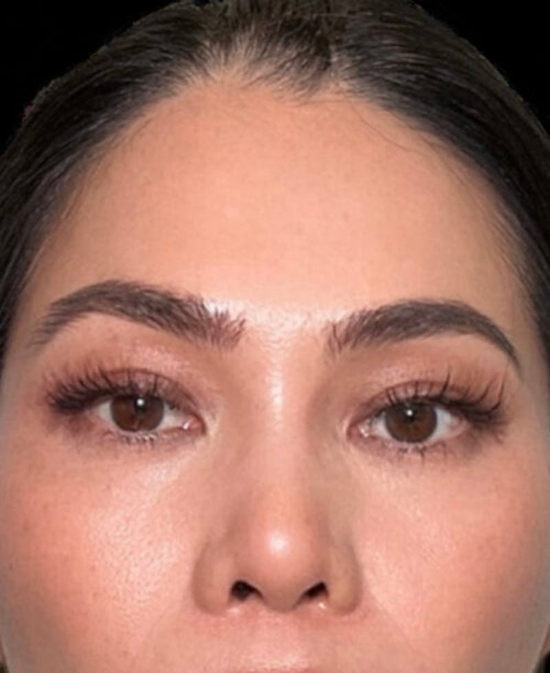 Blepharoplasty (Eyelid Surgery) Before & After Gallery - Patient 216175 - Image 2