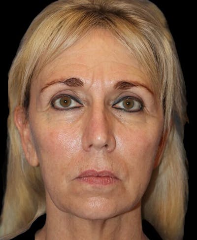 Blepharoplasty (Eyelid Surgery) Before & After Gallery - Patient 150554 - Image 1