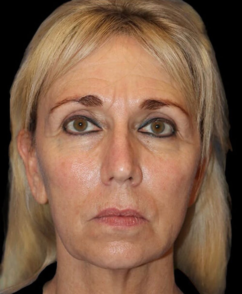 Blepharoplasty (Eyelid Surgery) Before & After Gallery - Patient 150554 - Image 1