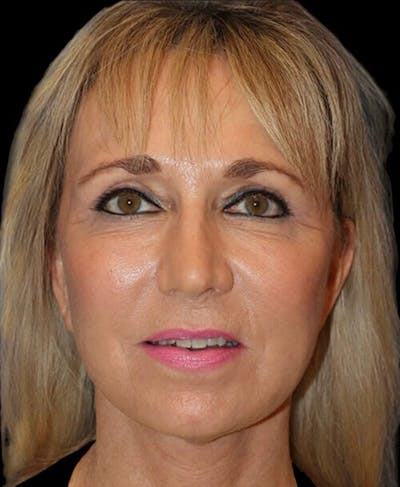 Blepharoplasty (Eyelid Surgery) Before & After Gallery - Patient 150554 - Image 2