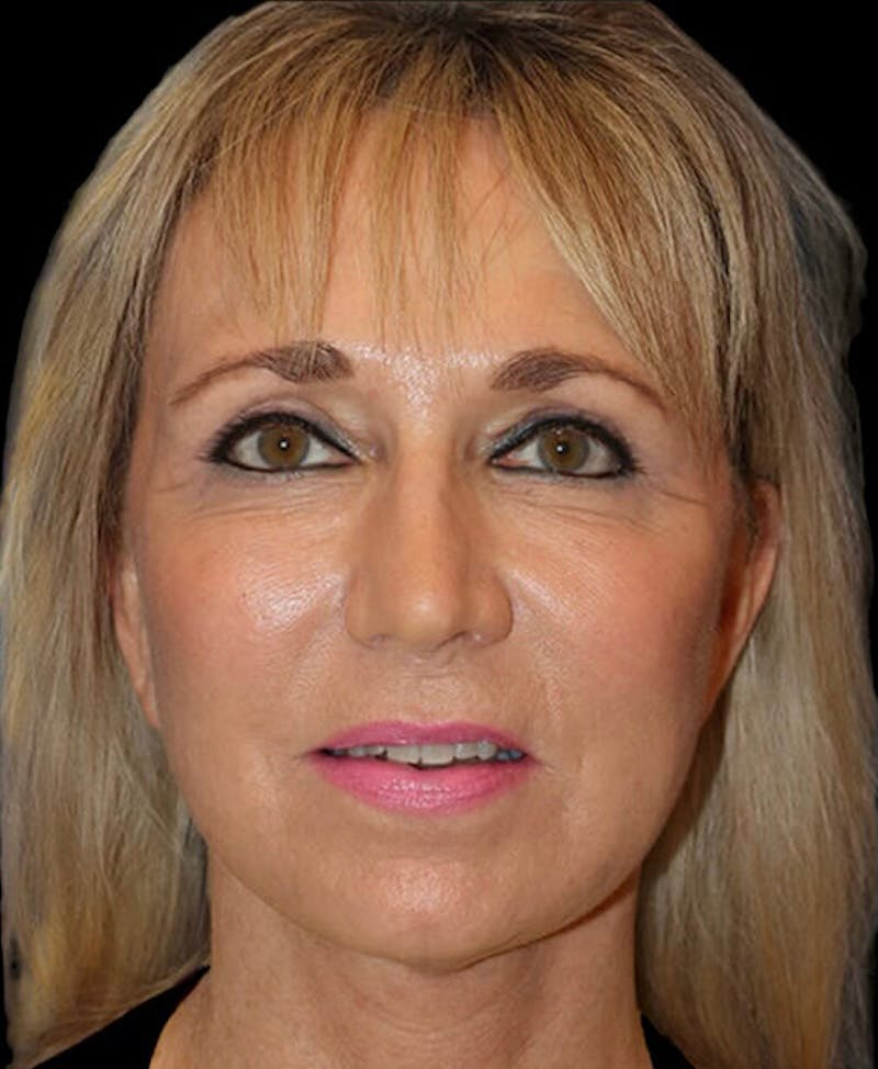 Blepharoplasty (Eyelid Surgery) Before & After Gallery - Patient 150554 - Image 2
