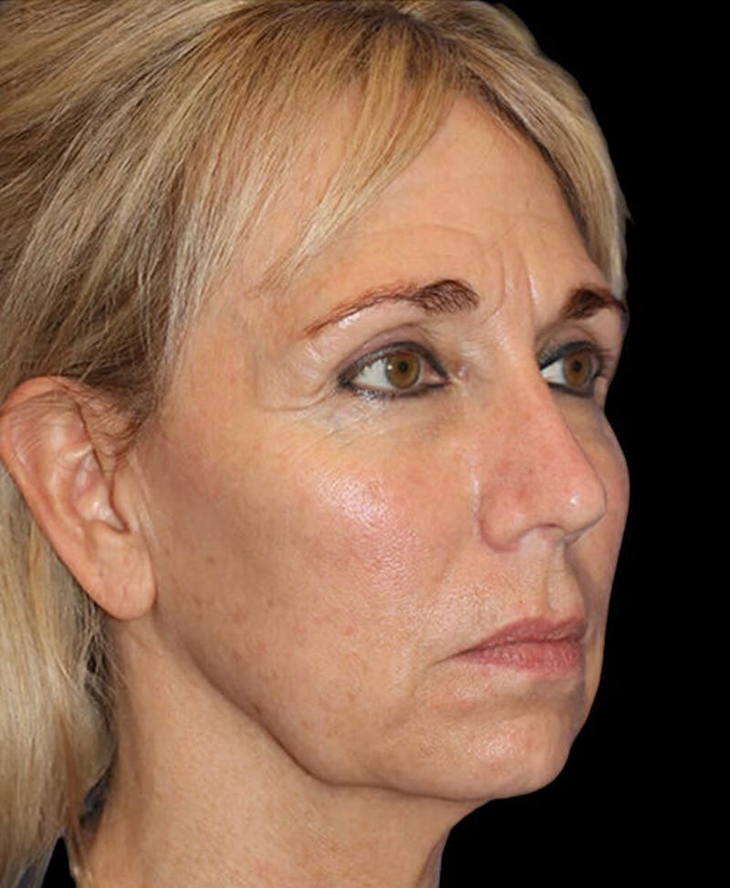 Blepharoplasty (Eyelid Surgery) Before & After Gallery - Patient 150554 - Image 3