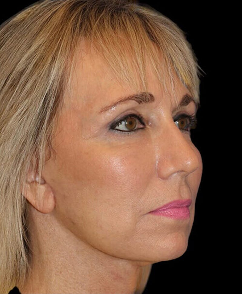 Blepharoplasty (Eyelid Surgery) Before & After Gallery - Patient 150554 - Image 4