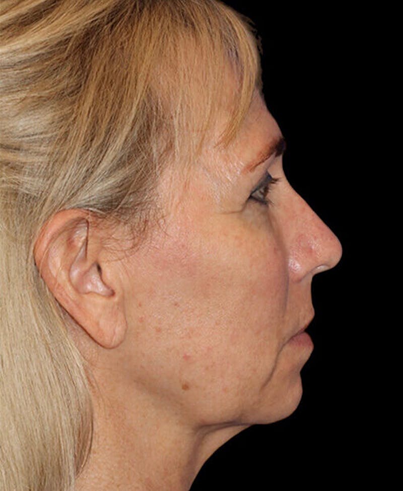 Blepharoplasty (Eyelid Surgery) Before & After Gallery - Patient 150554 - Image 5