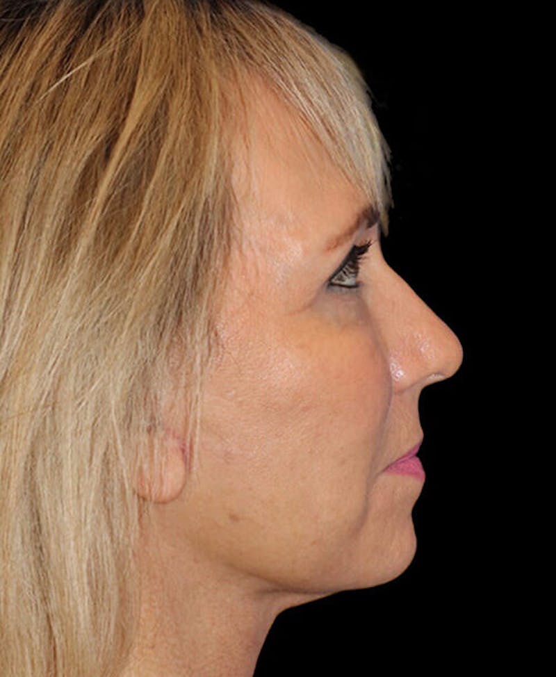 Blepharoplasty (Eyelid Surgery) Before & After Gallery - Patient 150554 - Image 6