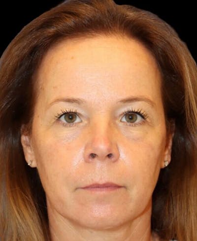 Blepharoplasty (Eyelid Surgery) Before & After Gallery - Patient 137214 - Image 1
