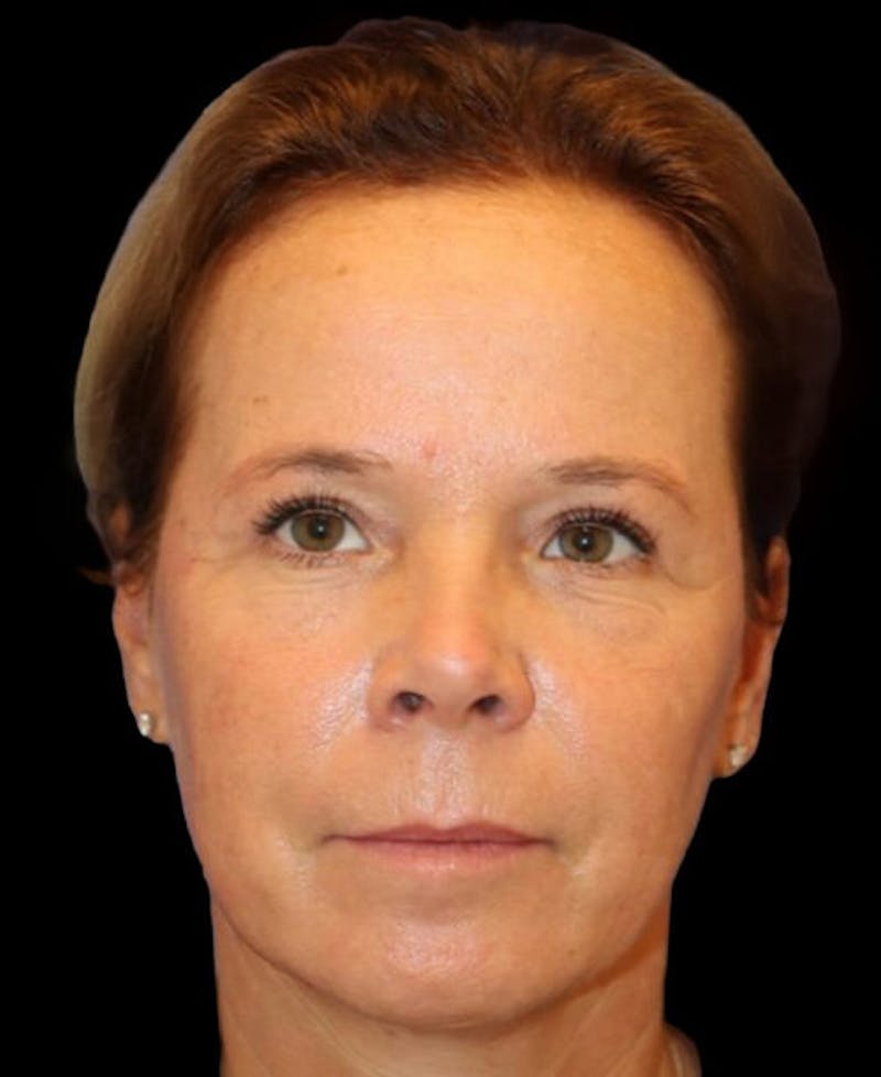 Blepharoplasty (Eyelid Surgery) Before & After Gallery - Patient 137214 - Image 2