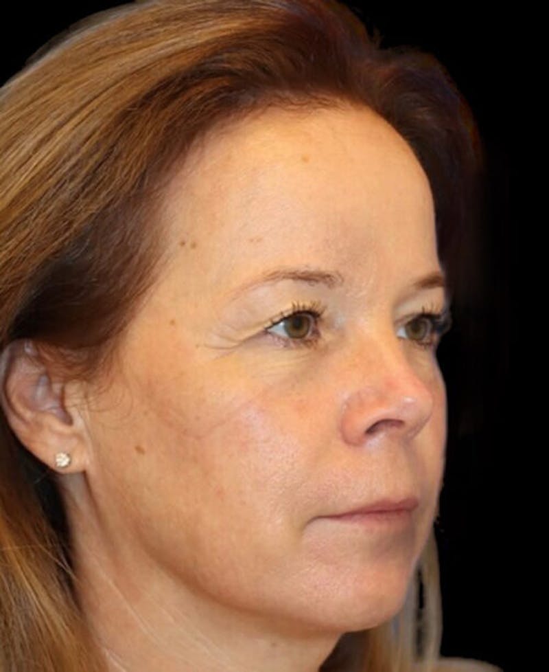 Blepharoplasty (Eyelid Surgery) Before & After Gallery - Patient 137214 - Image 3