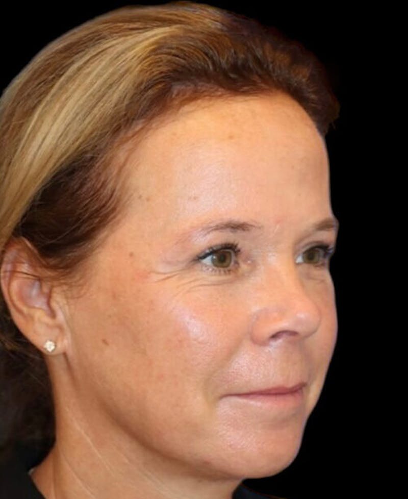 Blepharoplasty (Eyelid Surgery) Before & After Gallery - Patient 137214 - Image 4