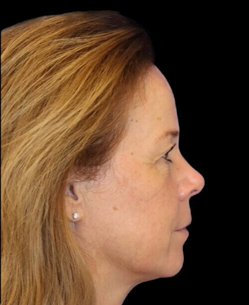 Blepharoplasty (Eyelid Surgery) Before & After Gallery - Patient 137214 - Image 5