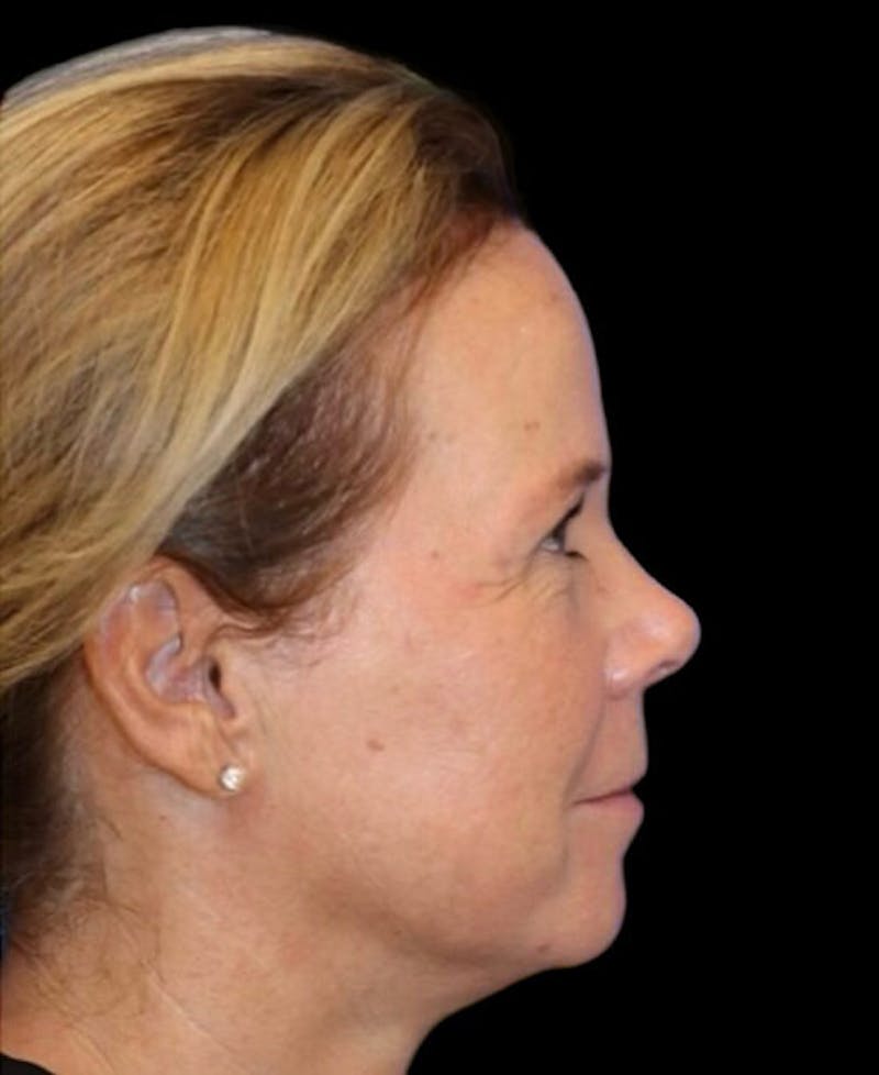 Blepharoplasty (Eyelid Surgery) Before & After Gallery - Patient 137214 - Image 6