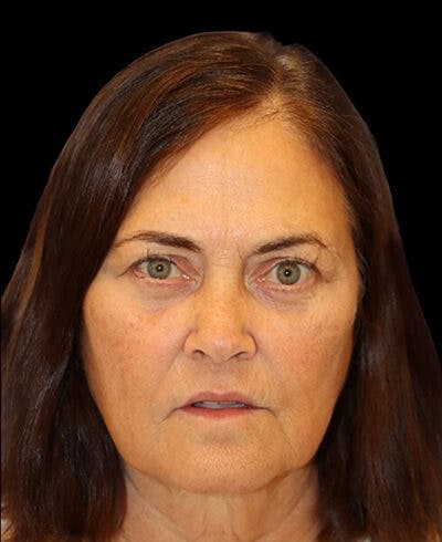 Blepharoplasty (Eyelid Surgery) Before & After Gallery - Patient 202555 - Image 1