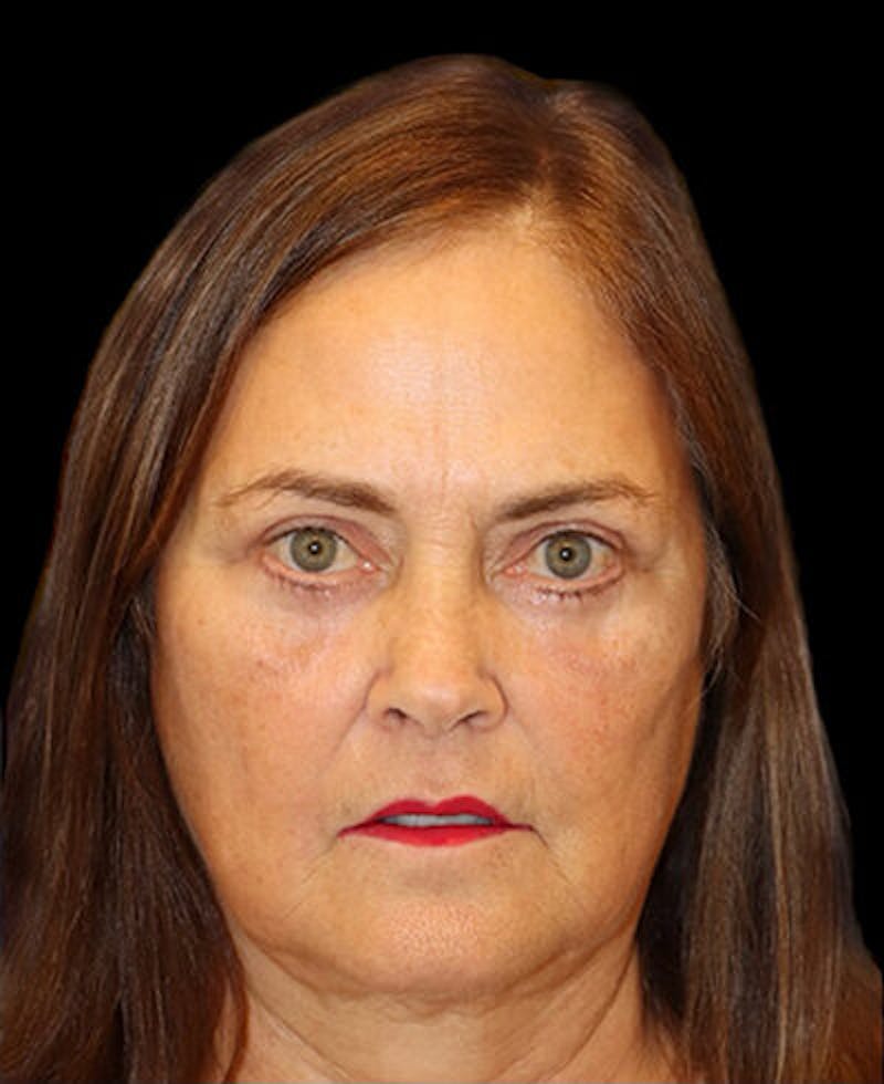 Blepharoplasty (Eyelid Surgery) Before & After Gallery - Patient 202555 - Image 2