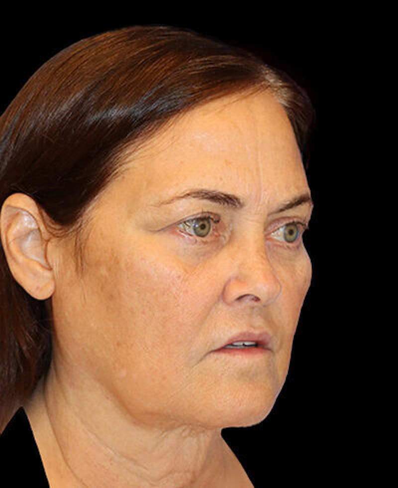 Blepharoplasty (Eyelid Surgery) Before & After Gallery - Patient 202555 - Image 3