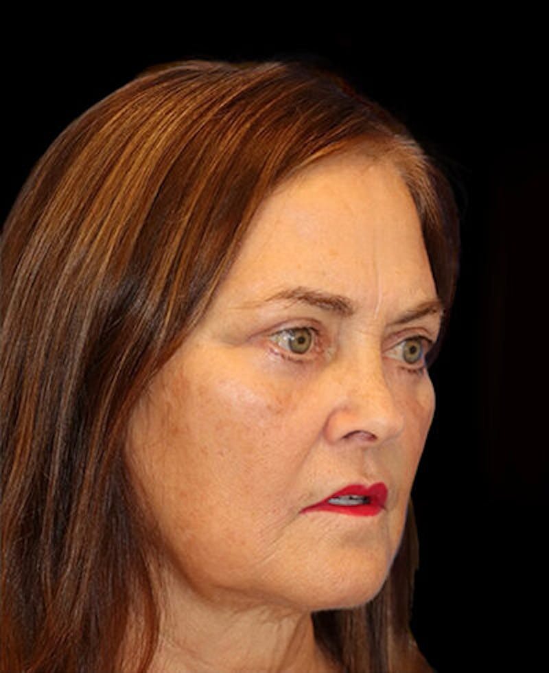 Blepharoplasty (Eyelid Surgery) Before & After Gallery - Patient 202555 - Image 4