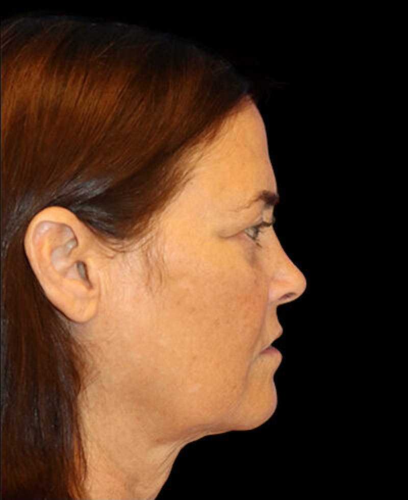 Blepharoplasty (Eyelid Surgery) Before & After Gallery - Patient 202555 - Image 5