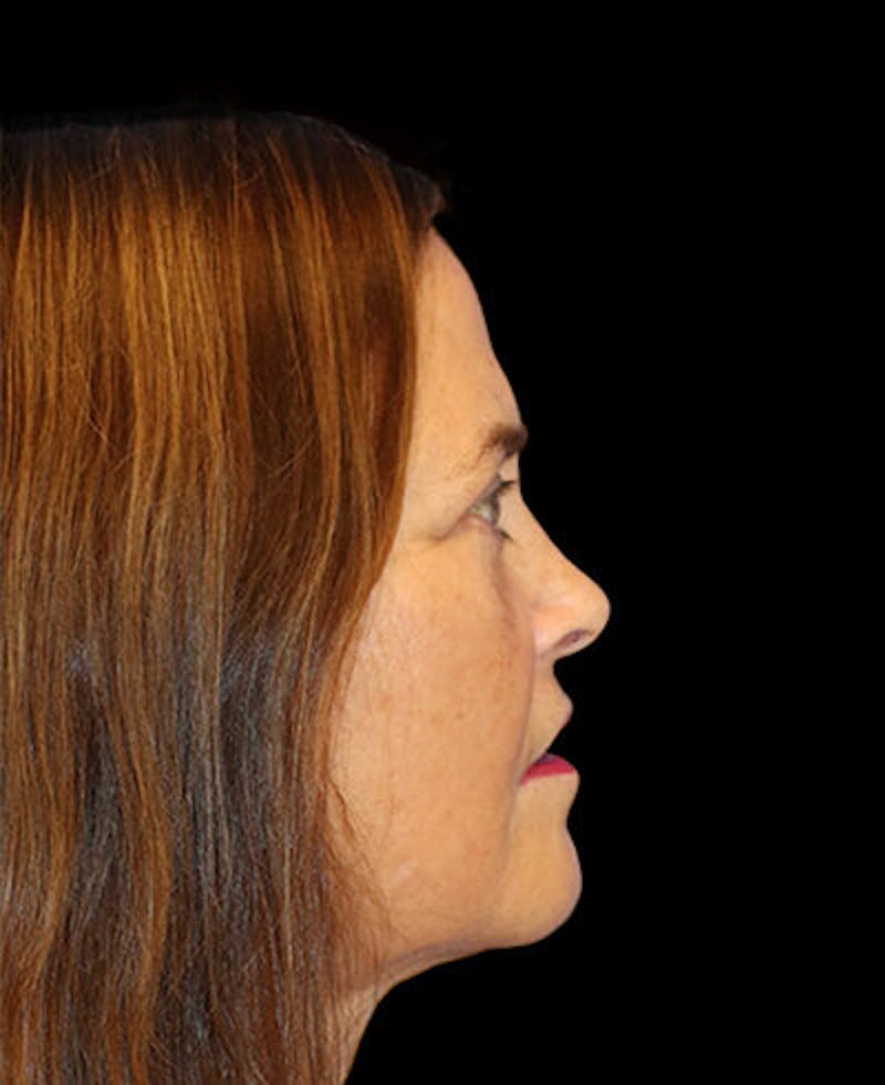 Blepharoplasty (Eyelid Surgery) Before & After Gallery - Patient 202555 - Image 6