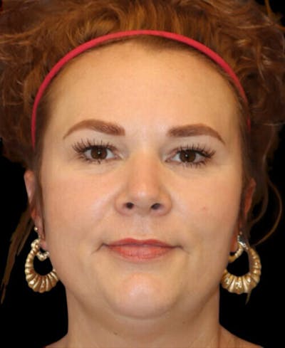 Blepharoplasty (Eyelid Surgery) Before & After Gallery - Patient 237961 - Image 1