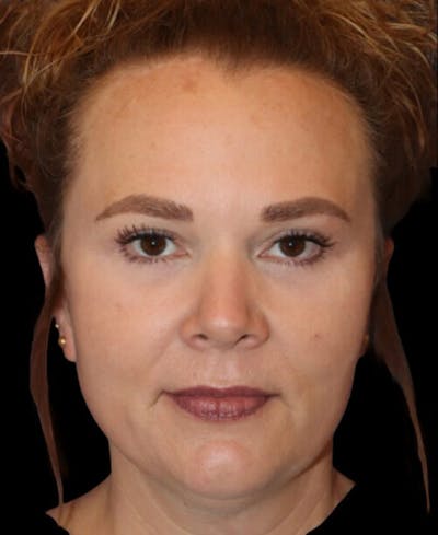 Blepharoplasty (Eyelid Surgery) Before & After Gallery - Patient 237961 - Image 2