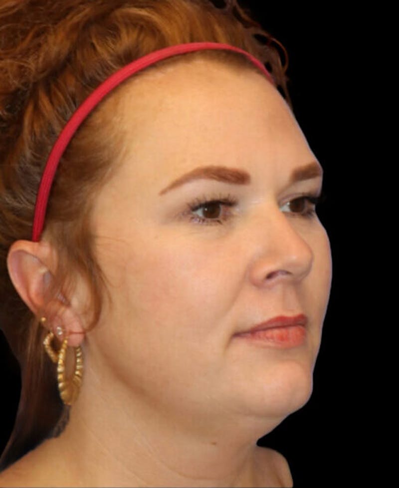 Blepharoplasty (Eyelid Surgery) Before & After Gallery - Patient 237961 - Image 3