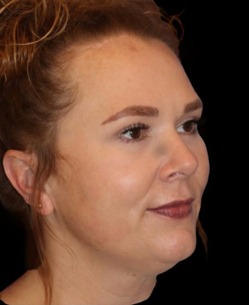 Blepharoplasty (Eyelid Surgery) Before & After Gallery - Patient 237961 - Image 4