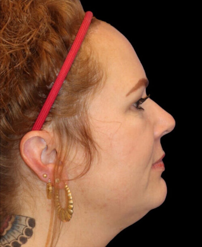 Blepharoplasty (Eyelid Surgery) Before & After Gallery - Patient 237961 - Image 5