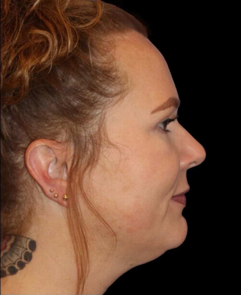 Blepharoplasty (Eyelid Surgery) Before & After Gallery - Patient 237961 - Image 6