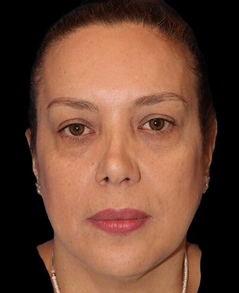 Blepharoplasty (Eyelid Surgery) Before & After Gallery - Patient 290089 - Image 1