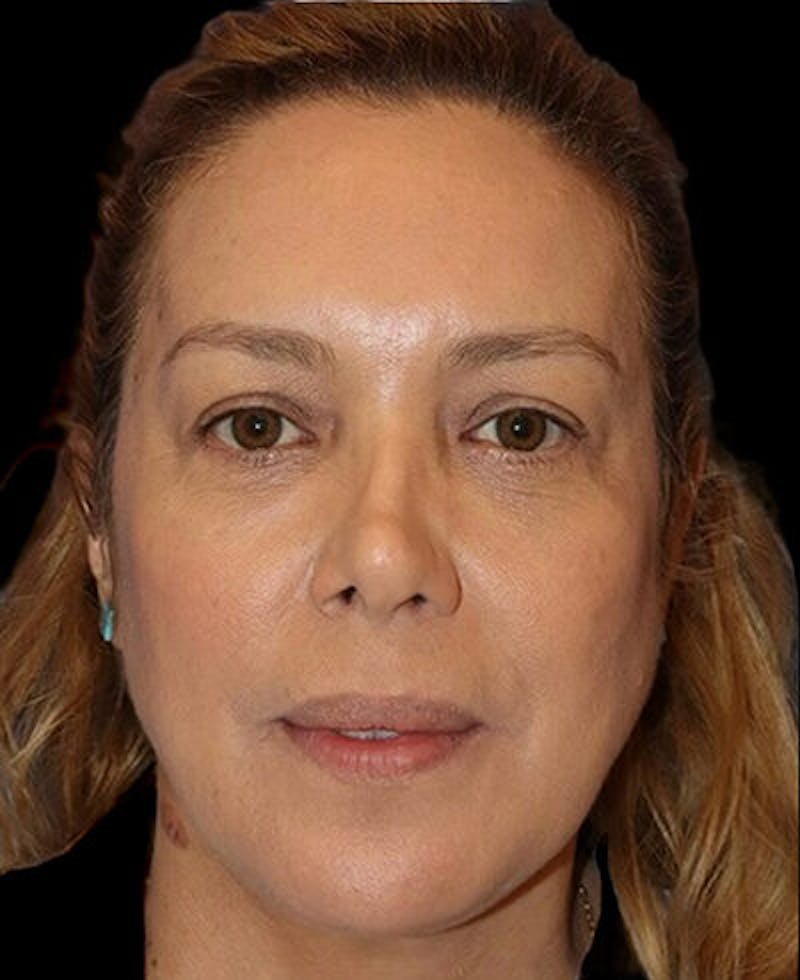 Blepharoplasty (Eyelid Surgery) Before & After Gallery - Patient 290089 - Image 2