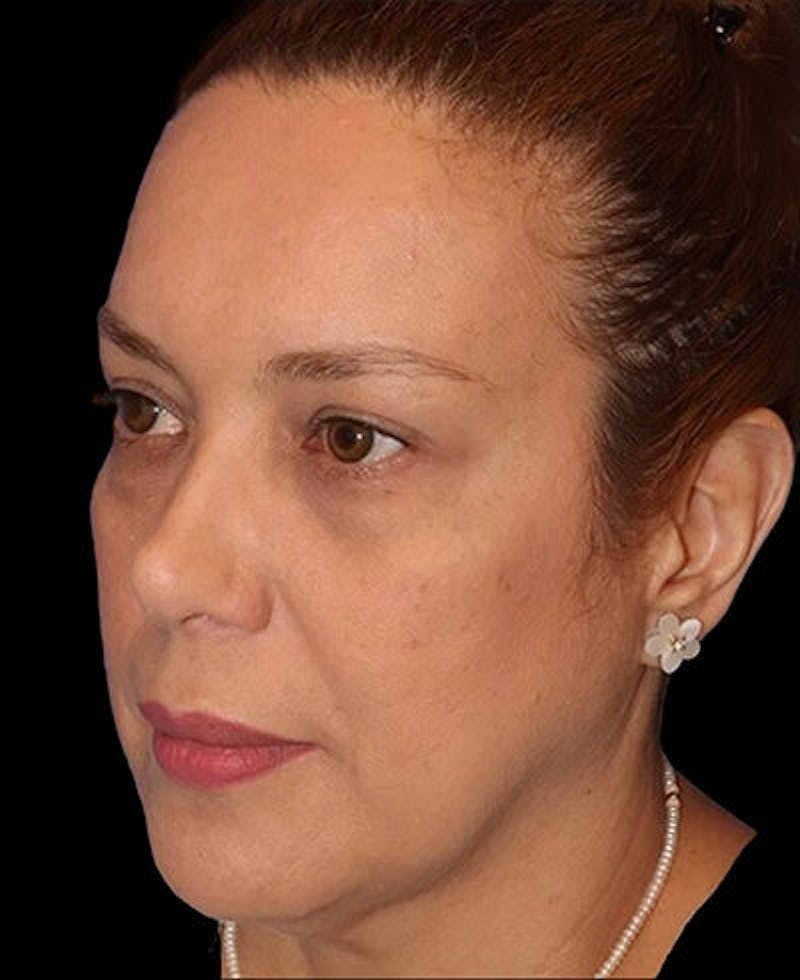 Blepharoplasty (Eyelid Surgery) Before & After Gallery - Patient 290089 - Image 3