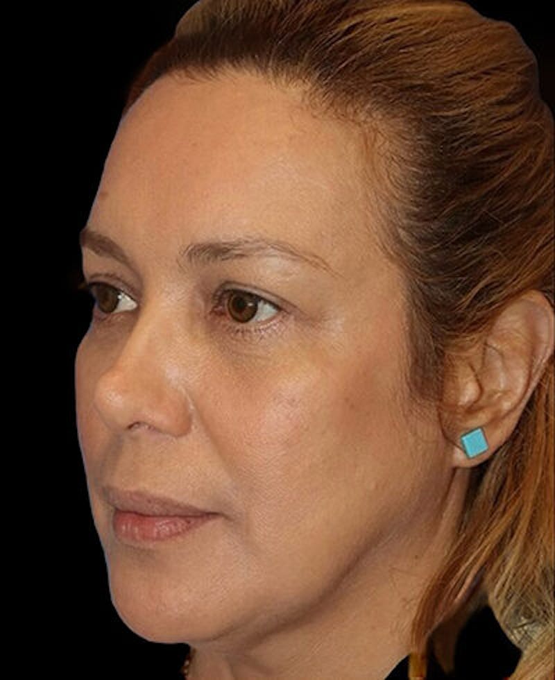 Blepharoplasty (Eyelid Surgery) Before & After Gallery - Patient 290089 - Image 4